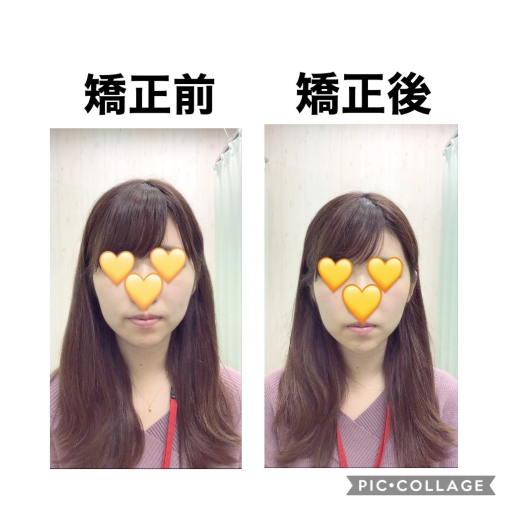 小顔矯正はじめました💆🏻‍♀️✨